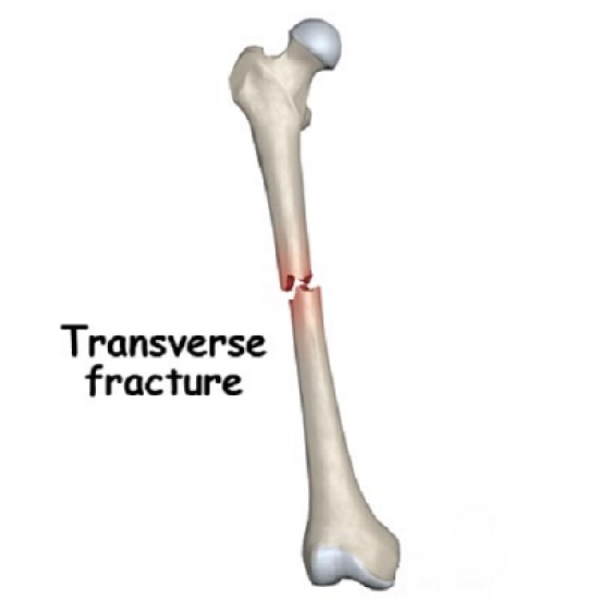 fracture عرضی