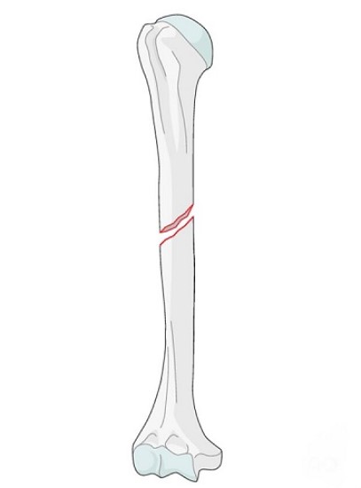 fracture مورب