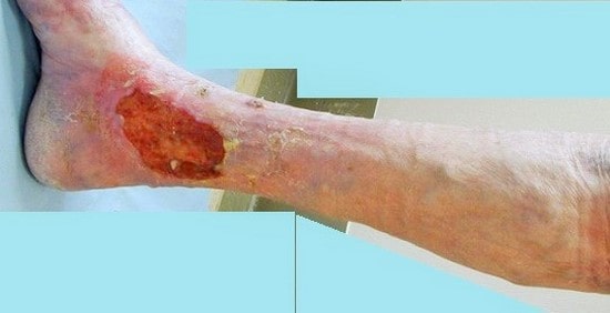 زخم های عروقی در نزدیکی قوزک پا